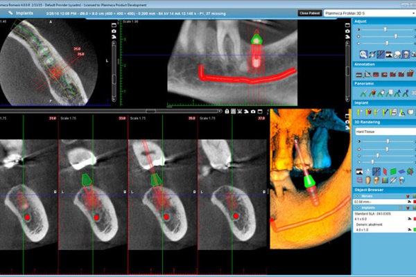 DVT Implantatplanung - ZahnarztAubing Dr. Johannes Stern