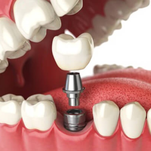 Schema: Implantat mit Krone