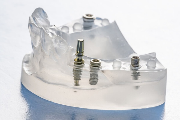 Modell mit mehreren Implantaten