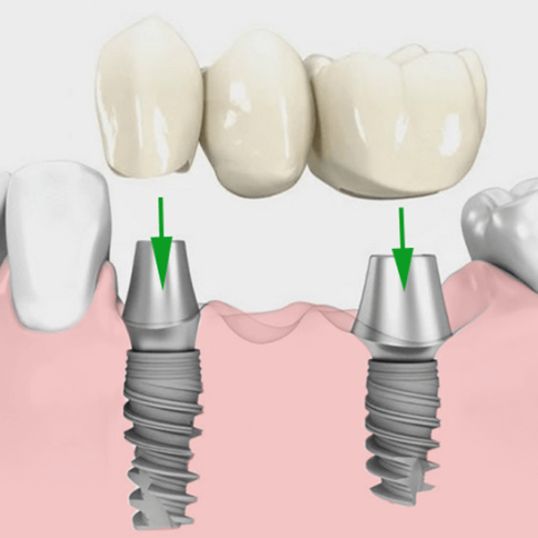 Implantatgetragene Brücke
