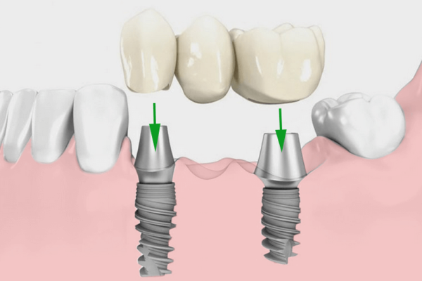 Implantatgetragene Brücke