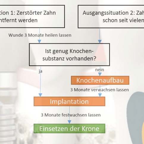 Ablauf der Implantation - ZahnarztAubing Dr. Johannes Stern